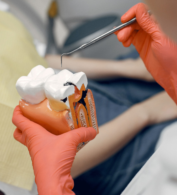 Dental procedure showing root canal treatment